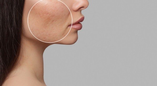 Acne: entenda sintomas, tratamento e cremes para cuidar da pele