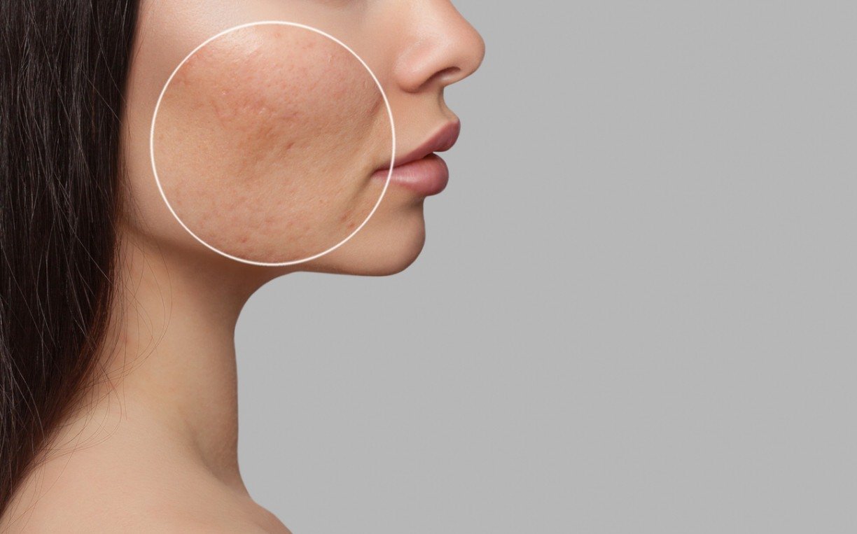 Imagem, Mulher com marcas de acne na bochecha. 