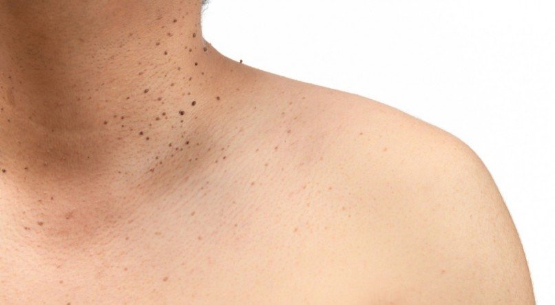 Imagem, homem com verrugas pelo corpo.