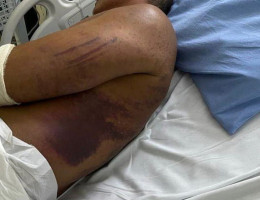 Foto do major da PM com hematomas no corpo após ser torturado em treinamento do Bope de Goiás