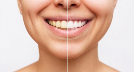 Tiro cortado de jovem sorrindo mulher antes e depois de dentes clareamento isolado em um fundo branco