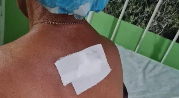 Foto do curativo nas costas da mãe sobre marca de facada causada pelo filho