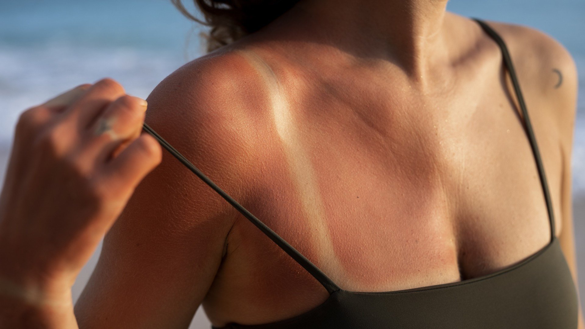 Imagem de: detalhes da pele queimada pelo sol da praia de uma mulher
