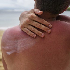 Imagem ilustrativa de um homem com as costas queimadas pelo sol, na praia, aplicando protetor solar