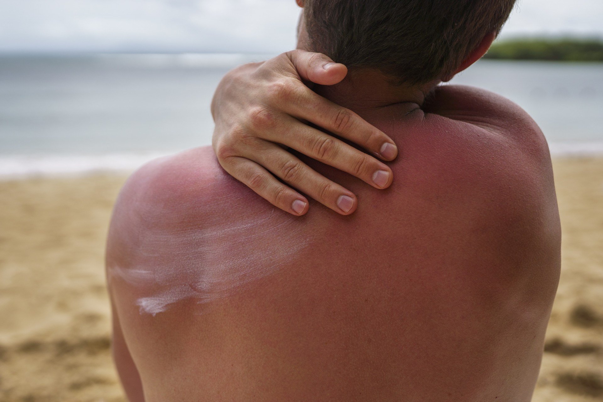 Imagem ilustrativa de um homem com as costas queimadas pelo sol, na praia, aplicando protetor solar