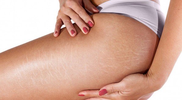 Imagem ilustra pernas femininas com estrias