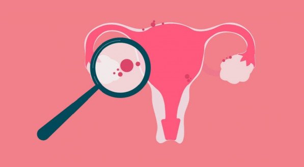 Endometriose: descubra os seis D’s por trás de uma das doenças mais comuns entre mulheres
