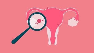 endometriose