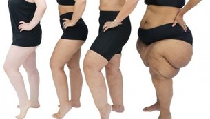 lipedema