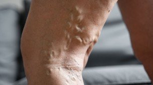 A úlcera venosa é a evolução das varizes