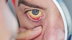 Coloração amarela nos olhos é um dos principais sintomas da hepatite