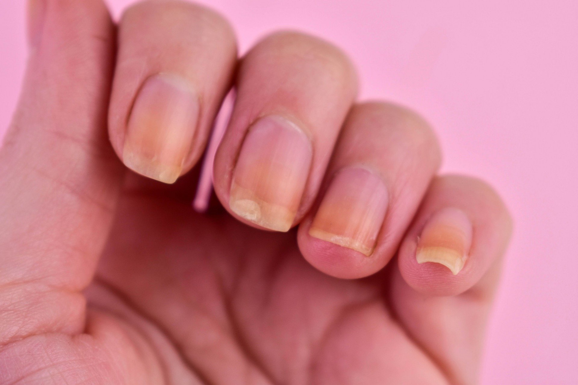 unhas