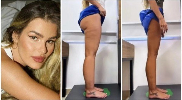 Lipedema