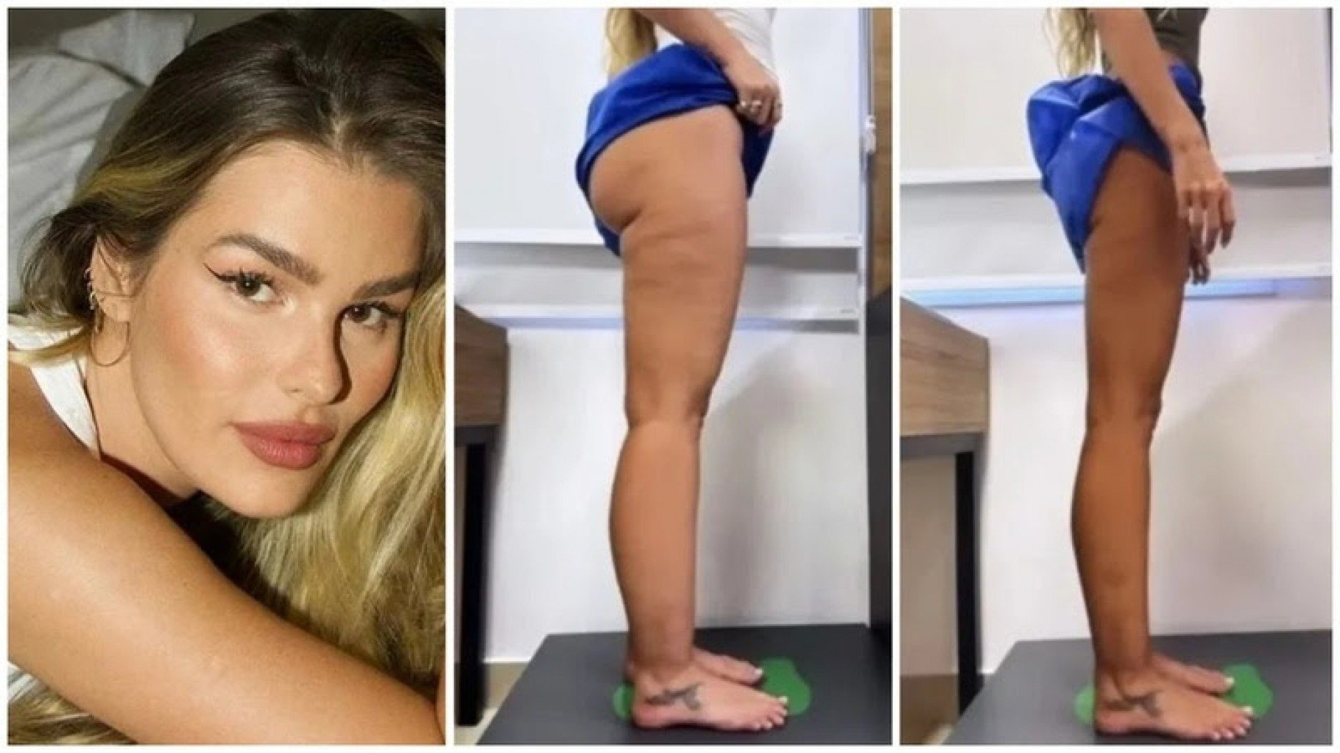 Lipedema e dietas: por que muitas mulheres não emagrecem mesmo comendo certo