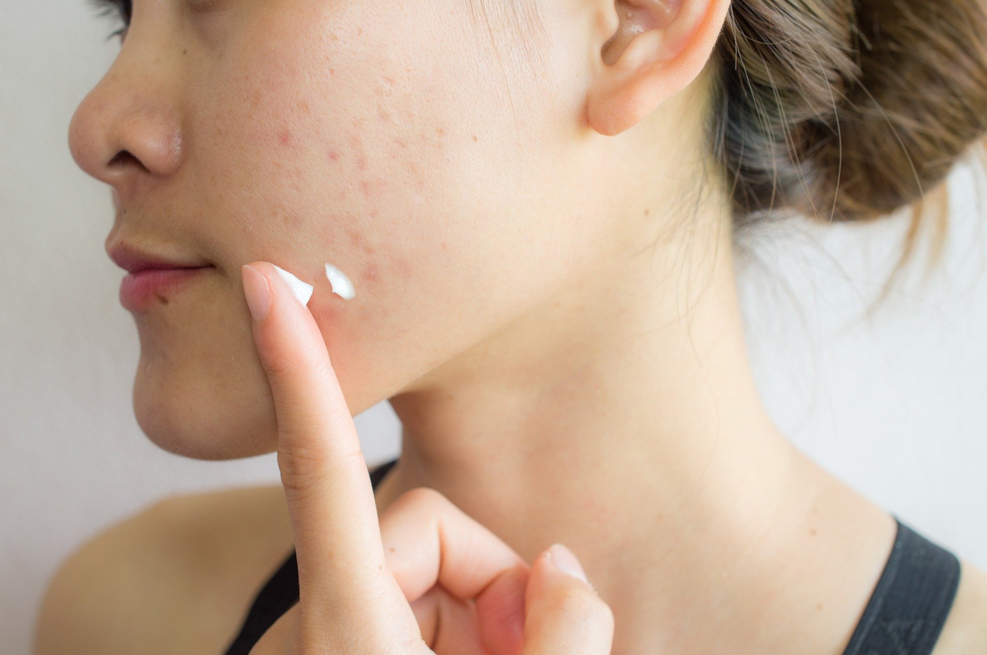 Skincare para pele acneica: o que realmente ajuda e o que piora a situação