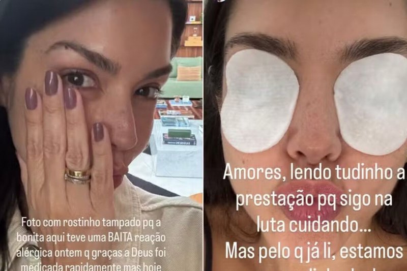 Thais Fersoza desabafa sobre reação alérgica: ‘Buldogue’