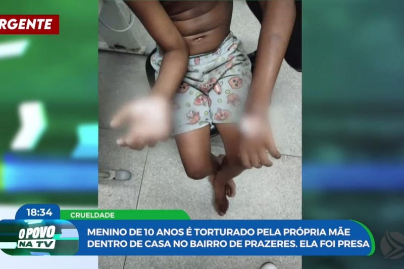 Imagem de menino com mãos feridas após tortura com colher e ovo quente