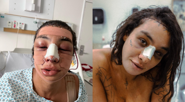 Linn da Quebrada: Entenda a cirurgia de feminização facial feita pela ex-BBB. Veja antes e depois