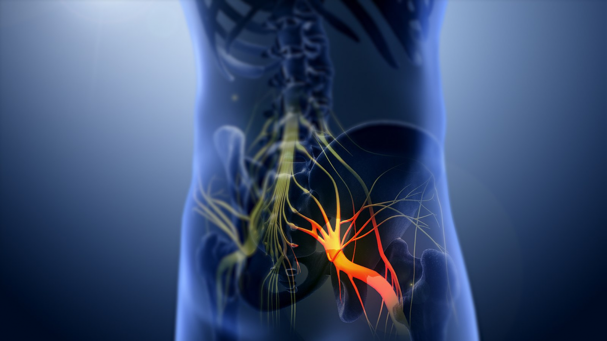 NERVO CIÁTICO INFLAMADO: veja 7 sinais de que está com o nervo ciático inflamado e como aliviar