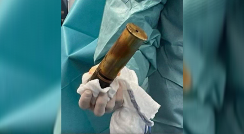 Idoso de 88 anos evacua hospital ao dar entrada com 'bomba' presa no ânus.