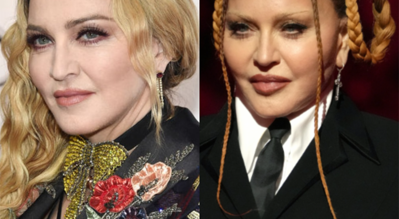 Até mesmo a Rainha do Pop, Madonna, aos 64 anos, realizou cirurgias plásticas no rosto