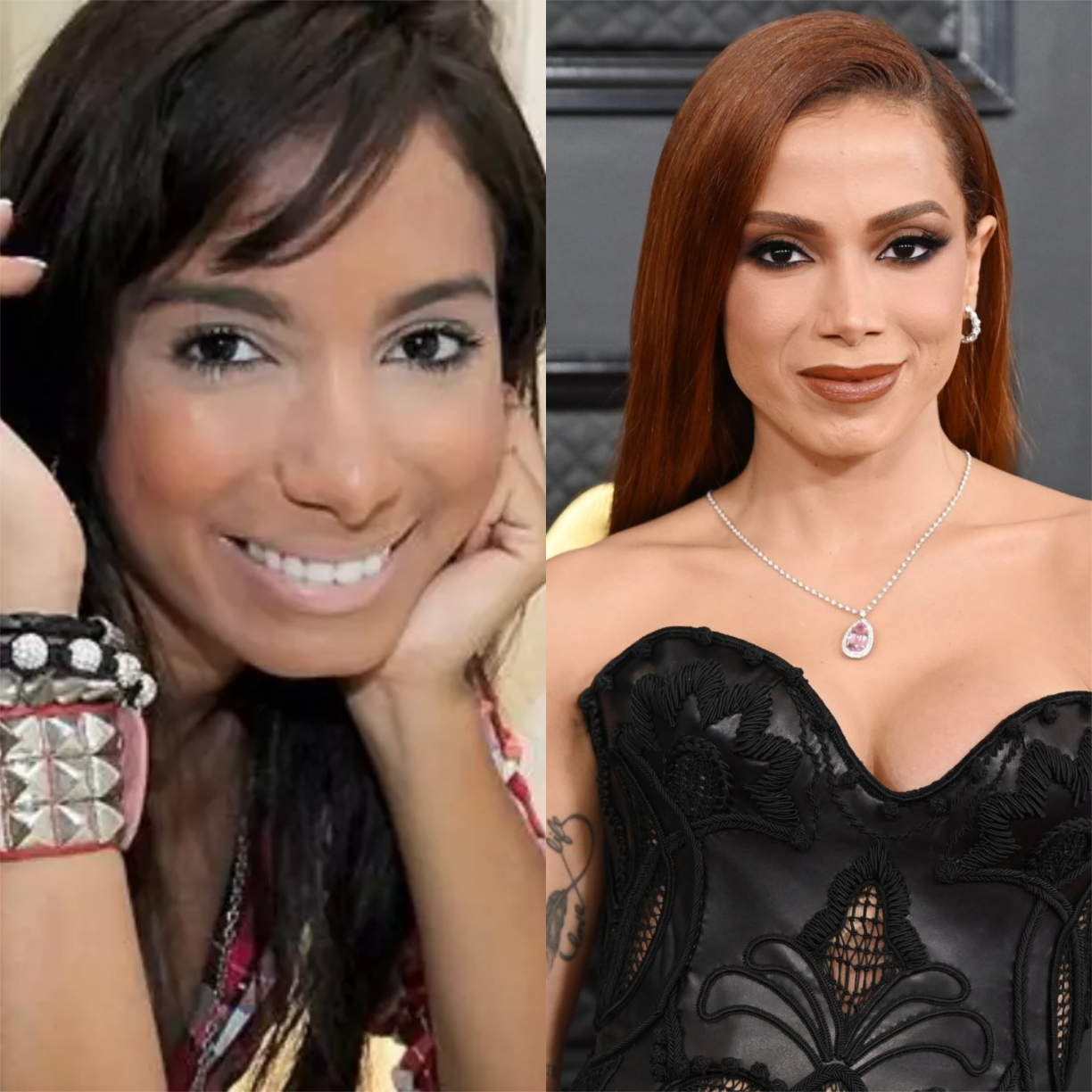 Anitta Antes E Depois Da Cirurgia 0685