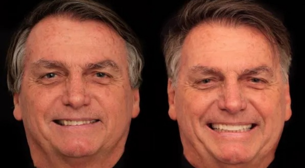 Bolsonaro faz harmonização facial