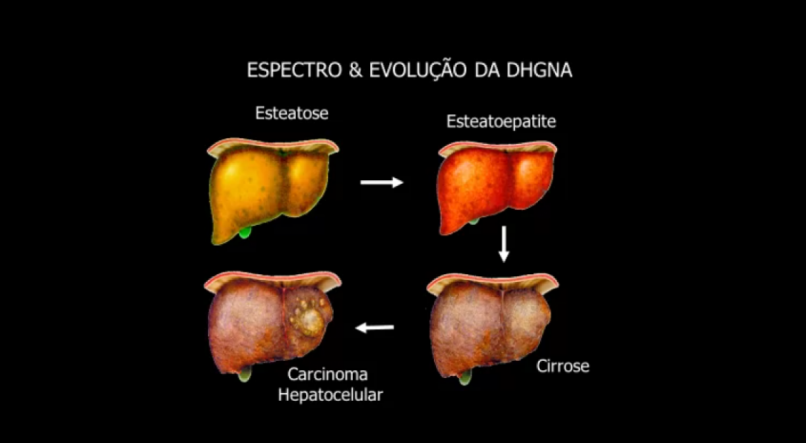 Se não tratada, gordura no fígado pode evoluir para cirrose e câncer de fígado