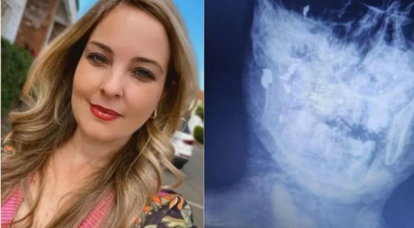 Raio-x realizado no corpo de Bruna Viviane Angleri, de 40 anos, mostra que a dentista foi baleada no rosto