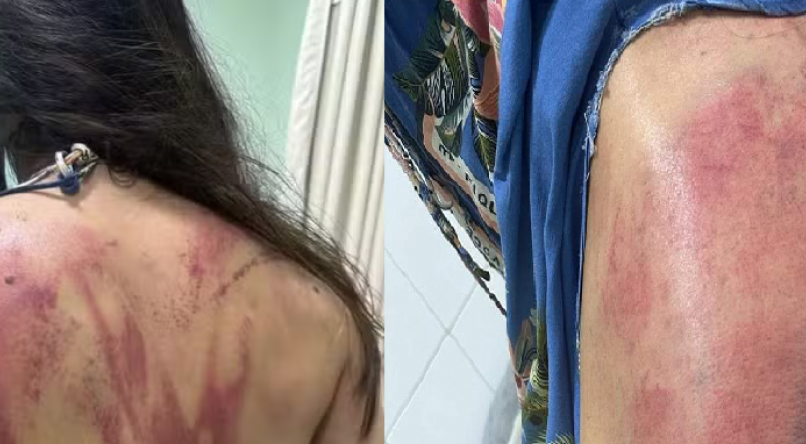 Mulher foi espancada pelo pai, hematomas foram causadas por facão