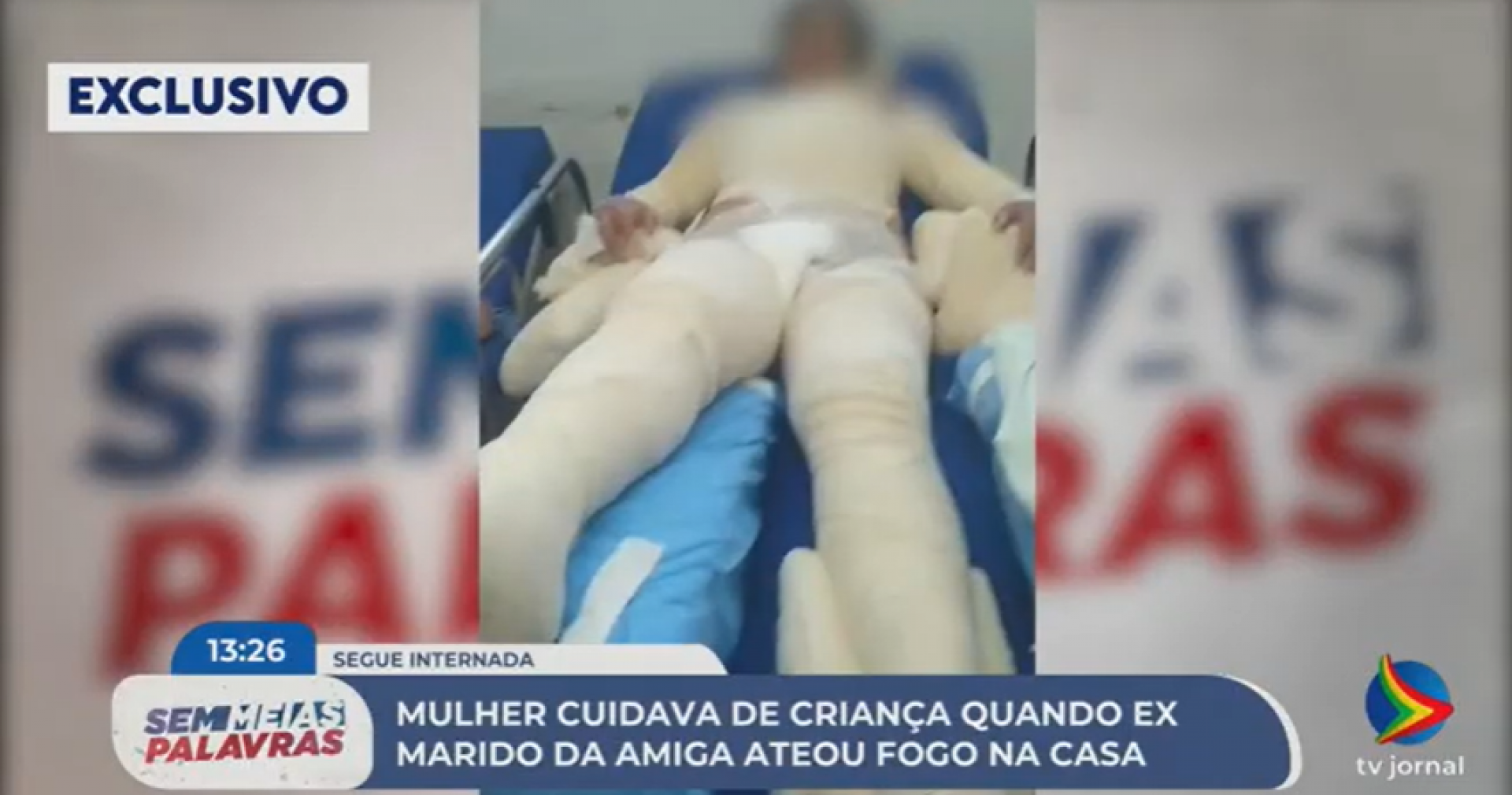 Imagem de mulher com queimaduras no Hospital da Restauração