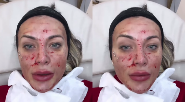 VÍDEO: Andressa Urach surge com rosto cheio de sangue e choca seguidores; saiba motivo