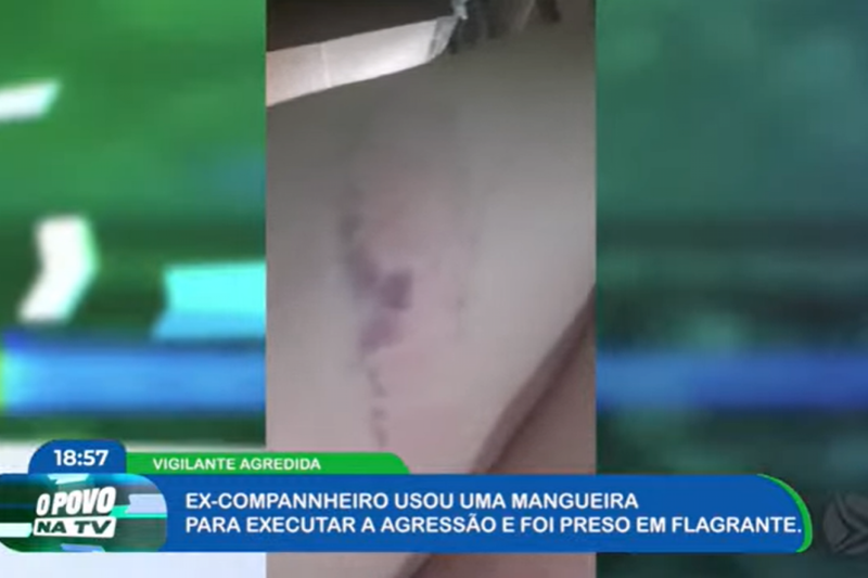 IImagem de hematoma na perna da vítima