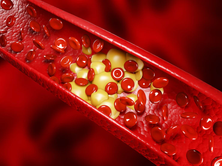 What are the symptoms of high cholesterol?  6 foods that raise cholesterol